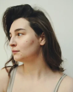 Ortie pour soulager l'acné, ortie piquante, belle peau, hormones, androgènes, bien être, santé, vivandglow