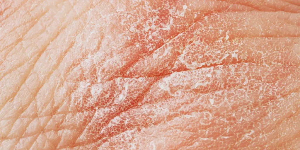 Peau endommagée