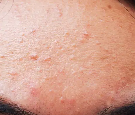 Acné fongique, folliculite à malazessia, boutons qui piquent, boutons qui démangent, acné, belle peau, les causes de l'acné fongique, vivandglow