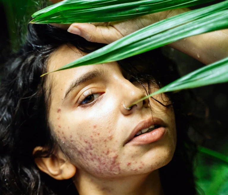 Acné, les causes de l'acné, p acnes, c acnes, problèmes cutanés, boutons, pores bouchés, système immunitaire, beauté, vivandglow
