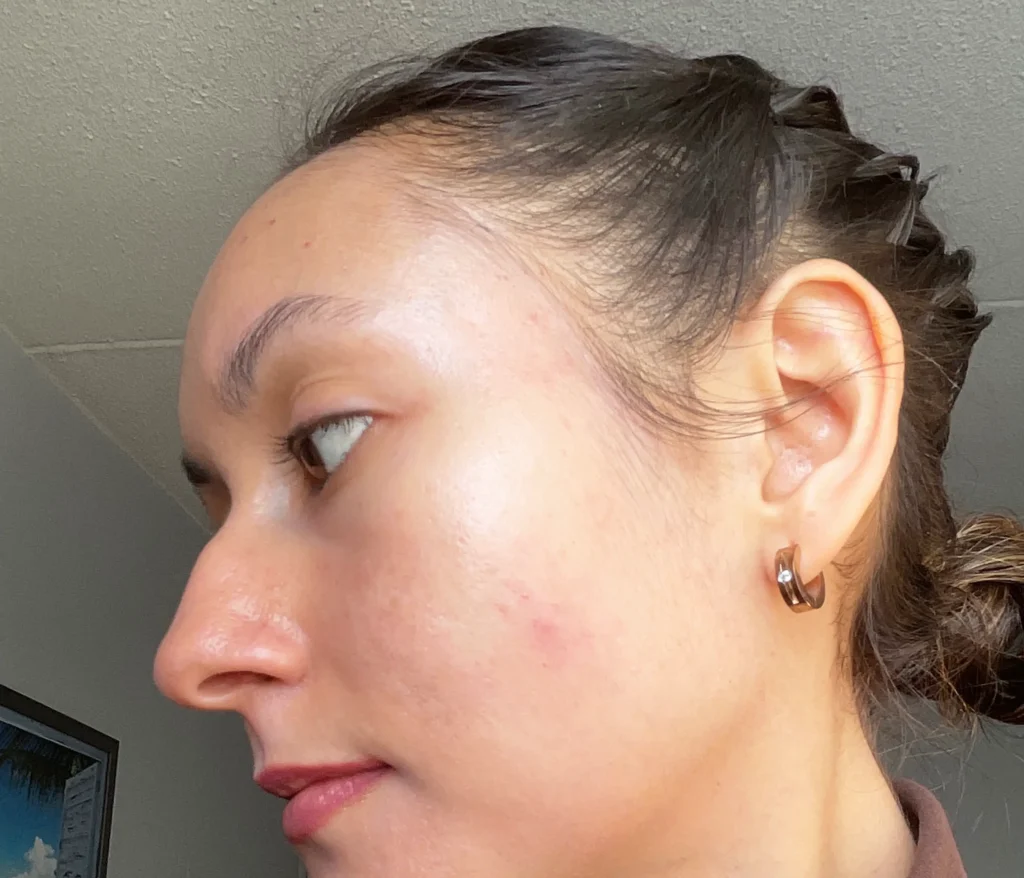 Blog, mon parcours avec l'acné, pilule, crème, dermatologue, antibiotiques, diane 35, vivandglow