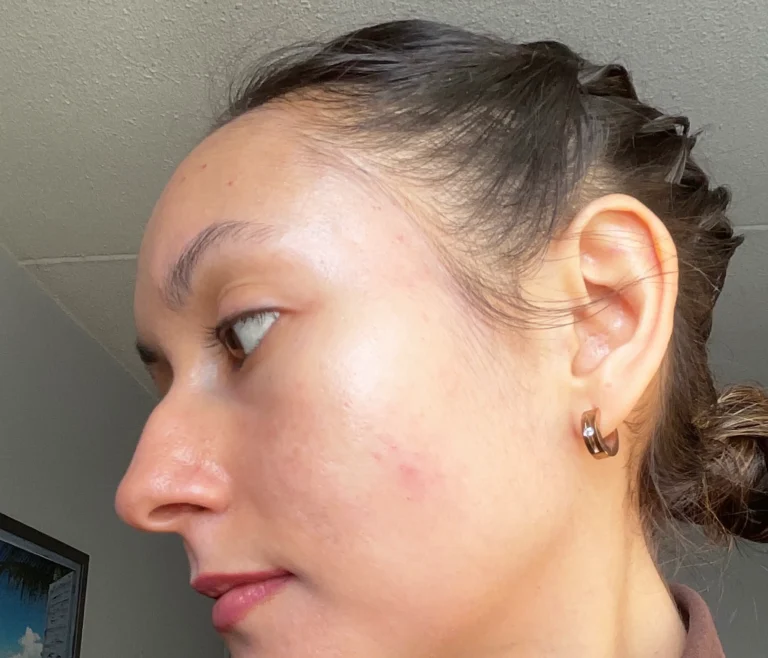 Blog, mon parcours avec l'acné, pilule, crème, dermatologue, antibiotiques, diane 35, vivandglow