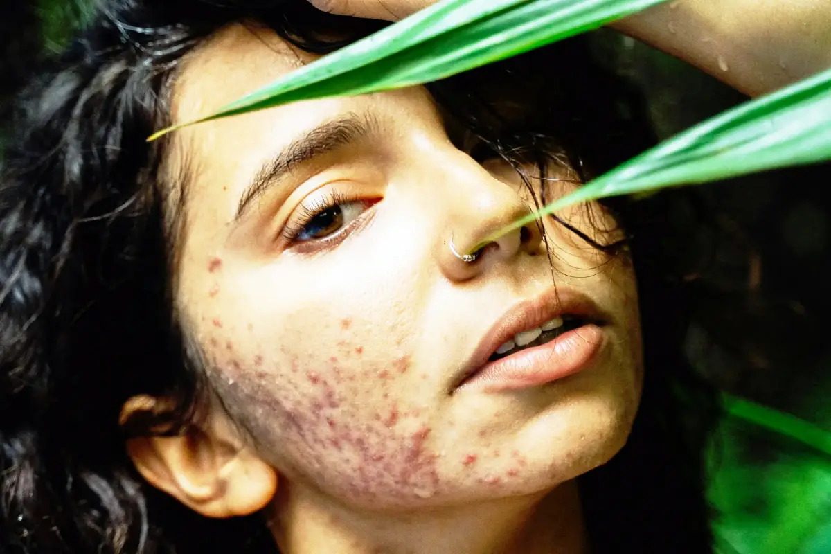 Les causes de l'acné