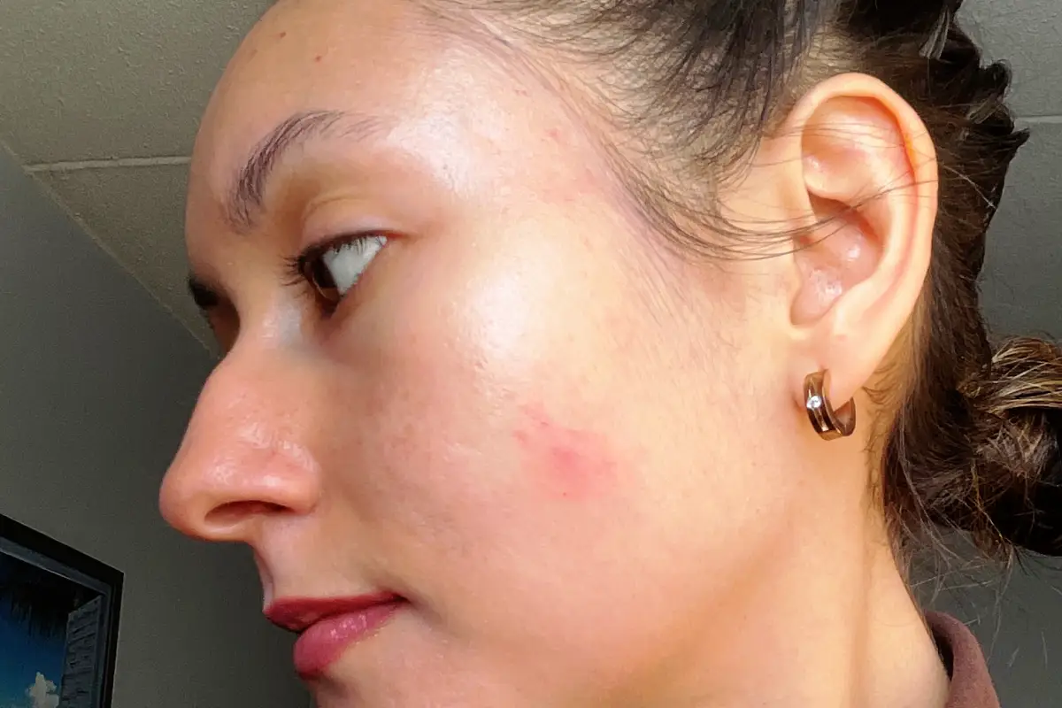 Mon histoire avec l'acné