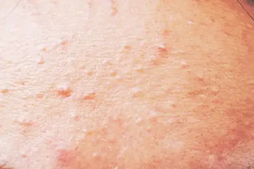 Acné fongique, boutons qui piquent, levure sur la peau.