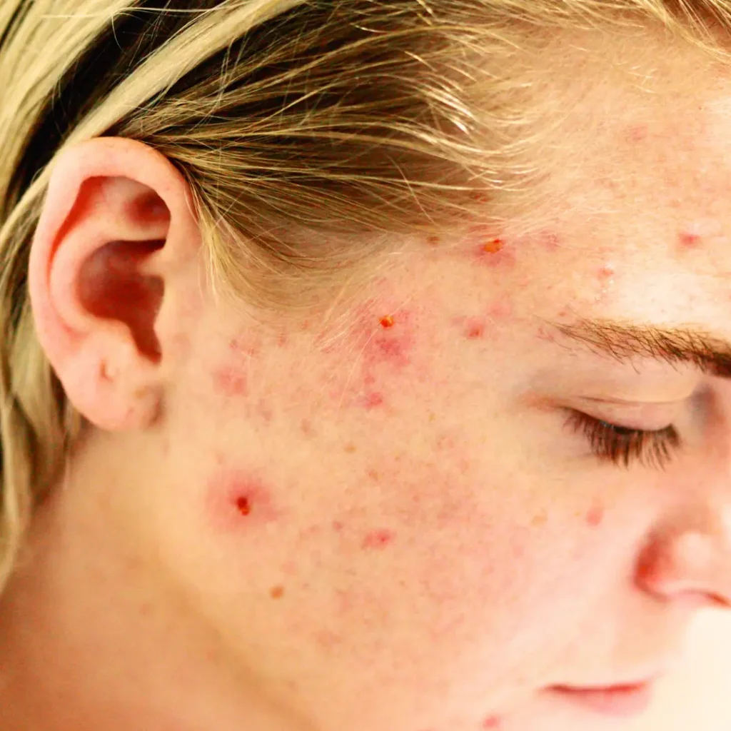 Acné, inflammation, système immunitaire suractivé, acné maladie de la peau inflammatoire, comédons, putules, papules, boutons, douleur, cicatrices, acné, vivandglow
