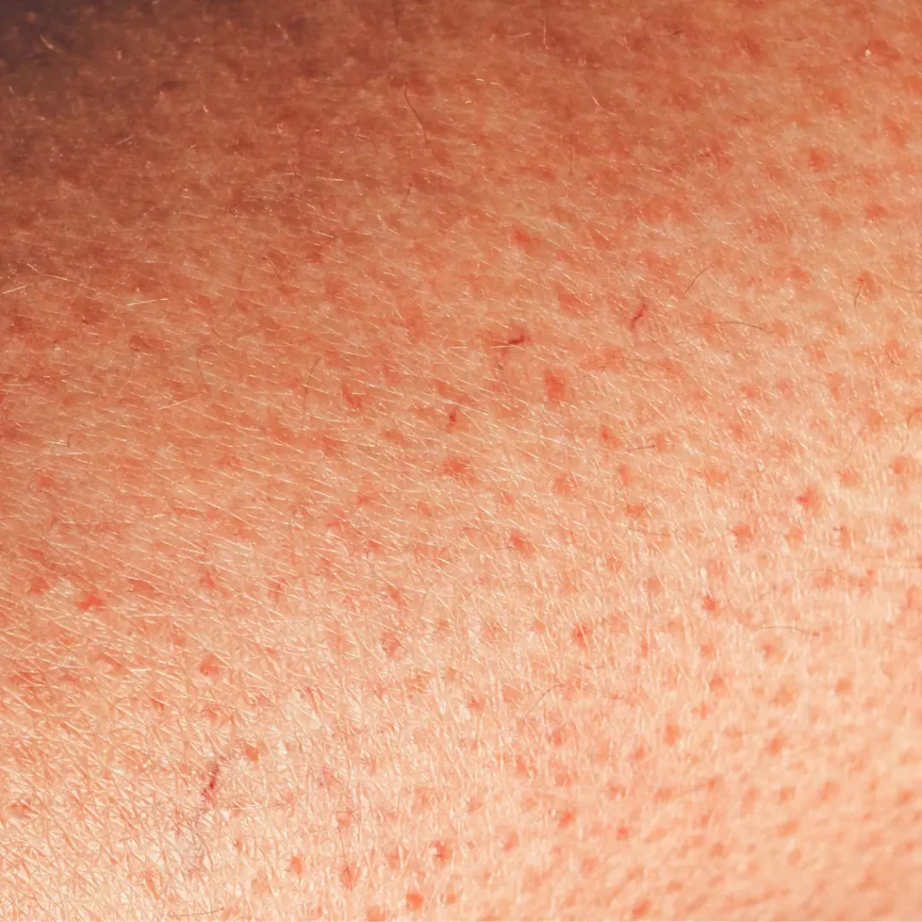 Hyperkératinisation, peau, kératine, pore bouché, acné, desquamation anomale, belle peau, hyperkératinisation de la peau, vivanglow