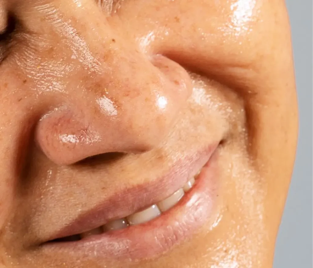 Peau grasse, glandes sébacées, production excessive de sébum, acné, pore bouchés, hormones, stress, alimentation, vivandglow