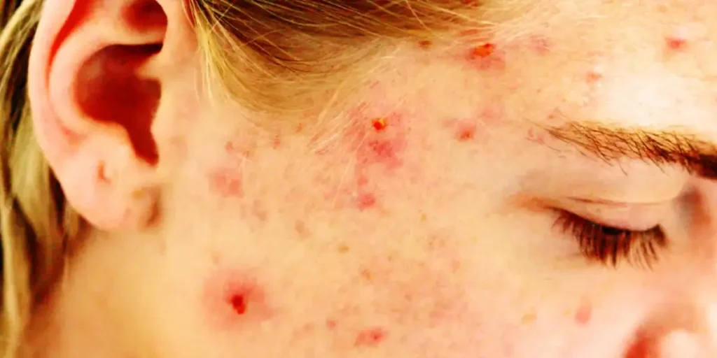 Inflammation et acné, système immunitaire et acné